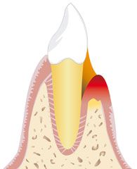 Parodontitisbehandlung